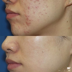 Crema <span class=keywords><strong>Viso</strong></span> OEM Rapida ed Efficace con Acido Salicilico ed Estratto di Centella Asiatica per Cicatrici da Brufoli, Rimozione Macchie, Gel Anti-Acne per una Pelle Liscia - Product Image 6