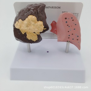 Modèle de comparaison des poumons sains et des poumons pathologiques ; Comparaison des poumons normaux et des poumons pathologiques ; Section anatomique de - Product Image 5