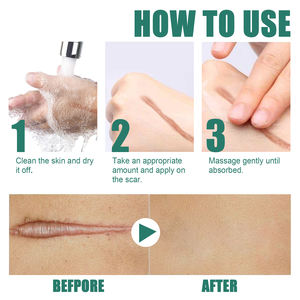 Crème chirurgicale pour enlever les cicatrices brûler le vieux visage traitement des cicatrices d'acné crème cicatrice lissante pour chirurgie - Product Image 4