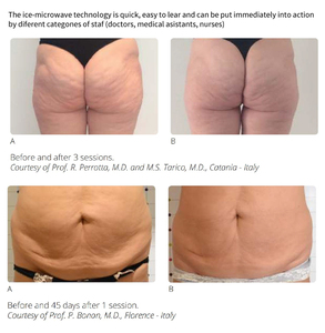 เครื่องทำความเย็นด้วยไมโครเวฟสำหรับบำบัดความเย็นและปรับรูปร่างใบหน้าและร่างกาย อุปกรณ์บำบัดด้วยอุณหภูมิต่ำ อุปกรณ์ความงามเชิงพาณิชย์ - Product Image 2
