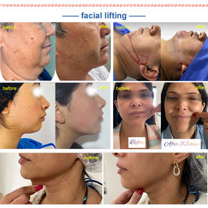 Máquinas profesionales de liposucción láser <span class=keywords><strong>no</strong></span> <span class=keywords><strong>invasiva</strong></span> 980nm 1470nm Lipólisis láser Endolaser Lifting facial - Product Image 5