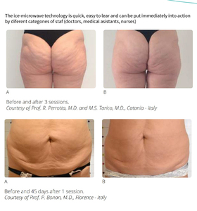 Coolwave Micro Wave 80% Fat Reduction Safe <b>Weight</b> Loss Body Slimming Air Cooling <b>Standing</b> ONDA Machine - Product Image 6