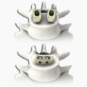 Implantes de fusión lumbar tipo V <span class=keywords><strong>Premier</strong></span> para materiales e accesorios intervencionistas de suministros médicos MOMO - Product Image 5