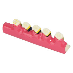 Modelo Anatómico de Periodoncia Oral para Gingivitis, Periodonitis Crónica, Clasificación de Grado, Comunicación Dental - Product Image 2