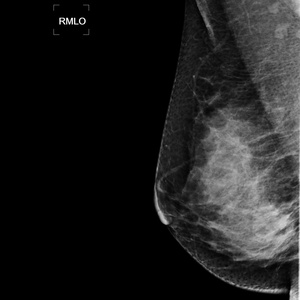 Système de mammographie numérique à prix avantageux, appareil à rayons X INM-5KW, tube à rayons X pour mammographie, détecteur à panneau plat, garantie 1 an, EOMED - Product Image 4
