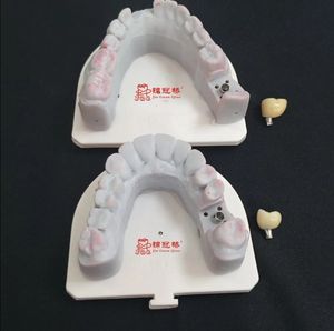 Impianto dentiere il modo migliore per trattare la perdita dei denti. Non danneggiare i denti adiacenti, evitare vicino al carico di forza del morso dei denti - Product Image 2