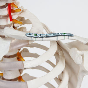 Implant de fixation en titane Geasure pour la réparation des traumatismes orthopédiques, pour la partie intermédiaire du bras et la clavicule distale, pour usage hospitalier, Classe III - Product Image 2