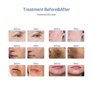 Láser Fraccional de <span class=keywords><strong>CO2</strong></span> de Alta Calidad de 10600nm y 1550nm, Combinación de Láser de <span class=keywords><strong>CO2</strong></span> y Erbio 2 en 1 para Rejuvenecimiento de la Piel - Product Image 3