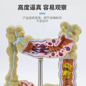 Modelos patológicos de intestino grueso, modelo de colon pequeño, modelo de lesiones del intestino grueso, enfermedades intestinales, modelo de lesiones del colon - Product Image 4