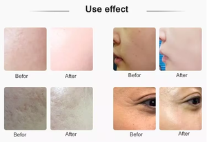 Portable Micro Needle Hyaluronic Meso Injector Mesotherapy Gun <strong>Price</strong> With Single Needle Skin Beauty Machine - Product Image 6