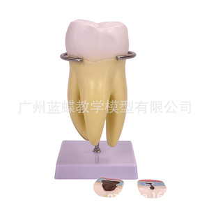 Molares ampliados 3 veces, patología dental completa, dientes transparentes, caries dentales, enseñanza de comunicación con pacientes dentales - Product Image 4