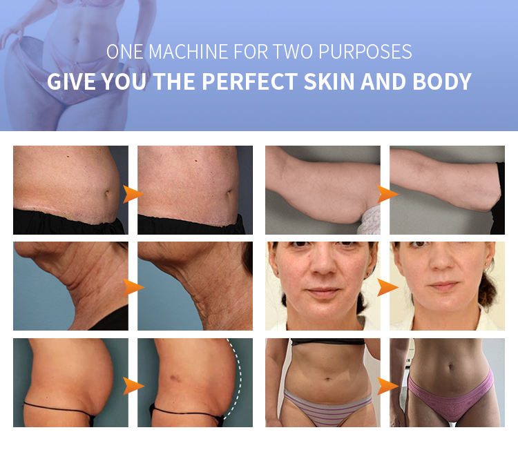 9d Lipo Hifu Liposuction Machine Skin Lifting Machine Fu4