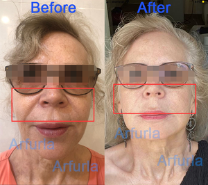 Lasermengangkat serat Endolaser portabel 1470nm + 980nm, peralatan Kecantikan pengurang lemak untuk kelopak wajah bawah - Product Image 2