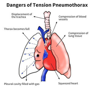 Jarum Pneumothorax Trauma Medis Kateter Dada Jarum Kateter 14g Jarum Dekompresi Digunakan untuk Mengobati Tensio - Product Image 6
