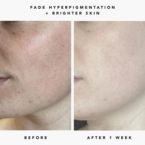 ETRUN Siero Viso Sbiancante con 2% Acido Kojico, Rimozione Macchie Scure, Occhiaie e Abbronzature, Schiarente per Pelle Danneggiata dal Sole - Product Image 6
