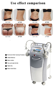 Dual Effects: <b>Cellulite</b> Reduction + Skin Tightening in One Session - Product Image 6