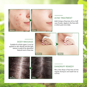 Aceite Esencial de Árbol de Té Nutritivo y Antibacteriano para el <span class=keywords><strong>Tratamiento</strong></span> del Acné, Cuidado de la Piel y Aromaterapia para Todo Tipo de Piel y Uso Corporal - Product Image 3