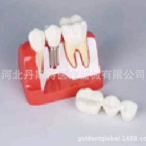 Modèle d'implant dentaire Dt M2017R, modèle anatomique en silicone médical pour l'enseignement des sciences médicales - Product Image 4