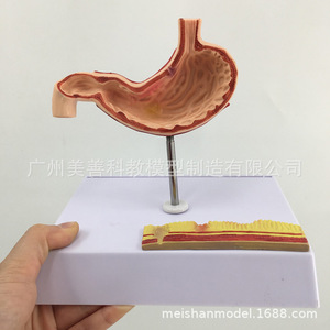 Modelo gástrico patológico en miniatura; modelo gástrico patológico perforado del estómago humano; gastroenterología; coronal - Product Image 3