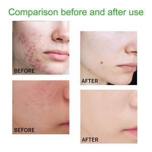 Nettoyant doux pour peaux grasses et sensibles, élimine les impuretés et l'excès de sébum, nettoyant visage rafraîchissant - Product Image 4