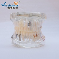 Restauration avec implant modèle de dents dentaires modèle d'enseignement des sciences médicales modèle de dents humaines