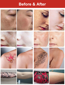 Appareil laser Pico professionnel 7 joints 360 °   Écran tactile de 10,4 pouces pour l'élimination des taches de naissance, des grains de beauté et des excroissances cutanées - Product Image 5