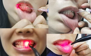 Laser Diode Dentaire Fibre Optique pour Blanchiment des Dents, Biostimulation, Physiothérapie et Traitement des Tissus Mous Dentaires - Product Image 2