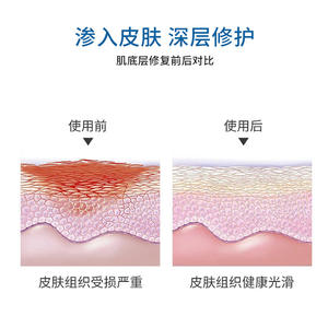 Gel para Hemorroides Sunflower Medical 5g 3 Tubos Para Hemorroides Internas y Mixtas Alivio de la Picazón y Hinchazón Anal - Product Image 2