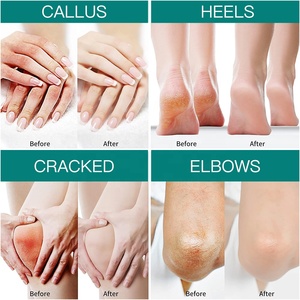 <span class=keywords><strong>Crème</strong></span> Soin des <span class=keywords><strong>Pieds</strong></span> <span class=keywords><strong>pour</strong></span> Talons Fissurés Exfoliante Anti-Crevasses Élimination Peaux Mortes Réparatrice Blanchissante <span class=keywords><strong>à</strong></span> <span class=keywords><strong>l</strong></span>'<span class=keywords><strong>Urée</strong></span> - Product Image 4