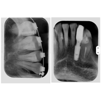 Nouvel arrivage : Appareil de radiographie dentaire intra-orale / Unité d'équipement de radiographie numérique portable avec capteur intégré RVG Rayos X