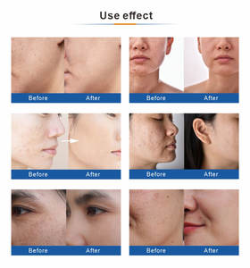 Traitement de l'acné du visage avec logo personnalisé Machine à peler les pores du visage 2 en 1 à 4 barres de nettoyage des pores du visage à jet d'oxygène Hydro Jet - Product Image 4