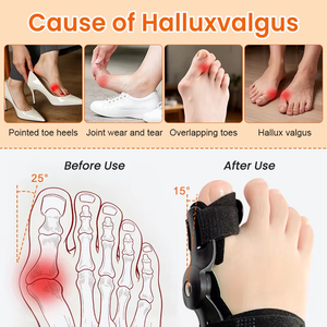Corrector Ortopédico de <span class=keywords><strong>Juanetes</strong></span> Aiwecare, Soporte de Alineación de Dedos <span class=keywords><strong>para</strong></span> Hallux Valgus, <span class=keywords><strong>para</strong></span> Alivio del Dolor y Recuperación - Flexible - Product Image 3