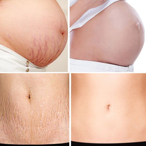 Lotion <span class=keywords><strong>Anti</strong></span>-vergetures, produit de corée pour enlever la <span class=keywords><strong>Cellulite</strong></span> <span class=keywords><strong>et</strong></span> les vergetures de marque, Lotion, ml - Product Image 3