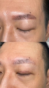 เครื่องเลเซอร์พกพา ND Yag Picosecond สำหรับลบรอยสัก ลอกคาร์บอน และลบกระ - Product Image 6