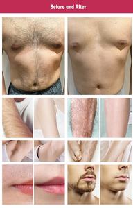 Professionnel 10bars diode laser épilation 755nm 808nm 1064nm diode laser épilation prix de la machine - Product Image 6