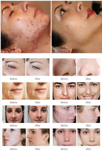 Mejor precio 2026: Láser fraccional de CO2 para rejuvenecimiento de la piel, equipo de láser fraccional de CO2 Vaingal para tensar la piel - Product Image 6