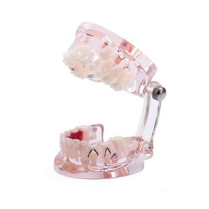 Gelsonlab HSDT-C8 Mixte Clair avec dents manquantes modèle de Dents Dentaires Pathologie Modèle D'étude Démonstration Modèle D'enseignement - Product Image 5