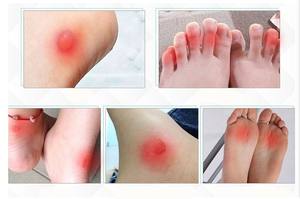 Tốt nhất người bán tiên tiến Hydrocolloid Băng vỉ chăm sóc gót chân các bản vá lỗi cho phòng ngừa và điều trị bán chạy ban nhạc AIDS - Product Image 6