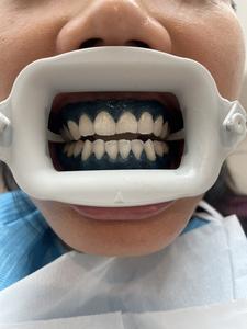 Pulizia dentale riutilizzabile ortodontico Comfort nero blu rosa Zoom denti sbiancamento linguetta in Silicone guancia riavvolgitore - Product Image 4