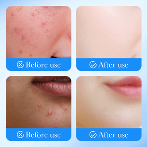 Patchs hydrocolloïdes personnalisés pour l'acné, 36 unités, pour couvrir les boutons et les imperfections, autocollants pour le visage et la peau - Product Image 5