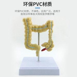 Modelos patológicos de intestino grueso, modelo de colon pequeño, modelo de lesiones del intestino grueso, enfermedades intestinales, modelo de lesiones del colon - Product Image 5