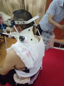 คลิปหนีบเสื้อฮาโลสำหรับการแพทย์ FM-TJ-003 อุปกรณ์ศัลยกรรมกระดูกและข้อ - Product Image 3