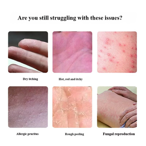 Parche Adhesivo Médico Antirreumático Externo con Hierbas Naturales para <span class=keywords><strong>el</strong></span> Alivio de la Psoriasis y <span class=keywords><strong>el</strong></span> Eccema, Hipoalergénico, para <span class=keywords><strong>el</strong></span> <span class=keywords><strong>Tratamiento</strong></span> de la Piel Seca y con Picazón - Product Image 3