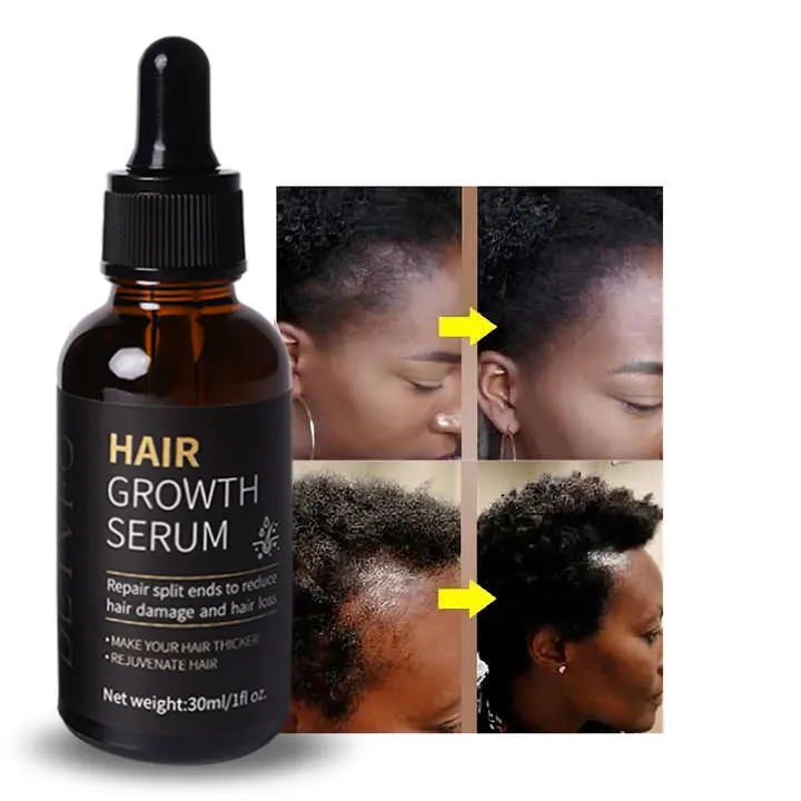 En iyi saç dökülmesi bakımı saç serumu büyüme organik yeniden büyüme tedavileri siyah kadınlar için saç büyüme yağı