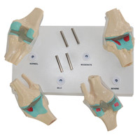Modèle d'articulation du genou en science médicale, ensemble d'arthrose à 4 étapes, articulation du genou pour le bureau des médecins, outil éducatif