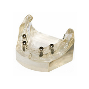 Uso dental Diferentes implantes Práctica Modelo de implante - Product Image 1