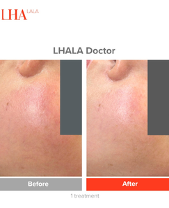 Peeling coréen Lha Lala Doctor Glass Skin, très vendu, pour les cicatrices d'acné et <span class=keywords><strong>la</strong></span> régénération de <span class=keywords><strong>la</strong></span> peau du visage. - Product Image 6