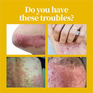 Crème <span class=keywords><strong>Bio</strong></span> Naturelle <span class=keywords><strong>pour</strong></span> le Psoriasis Adulte, Soin Eczéma, Soulagement Cutané Corporel, Extraits Végétaux, Bénéfices Détoxifiants, Fourniture de Soins Externes - Product Image 2