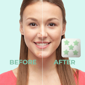 40 Cerotti Colorati a Forma di Stella <span class=keywords><strong>per</strong></span> <span class=keywords><strong>Acne</strong></span> e Brufoli con Custodia in Plastica e Specchio - Product Image 5