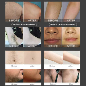 Appareil d'épilation au laser diode 808 nm 2 en 1, rajeunissement de la peau, picoseconde, picolaser, élimination des tatouages, élimination des taches de rousseur - Product Image 4